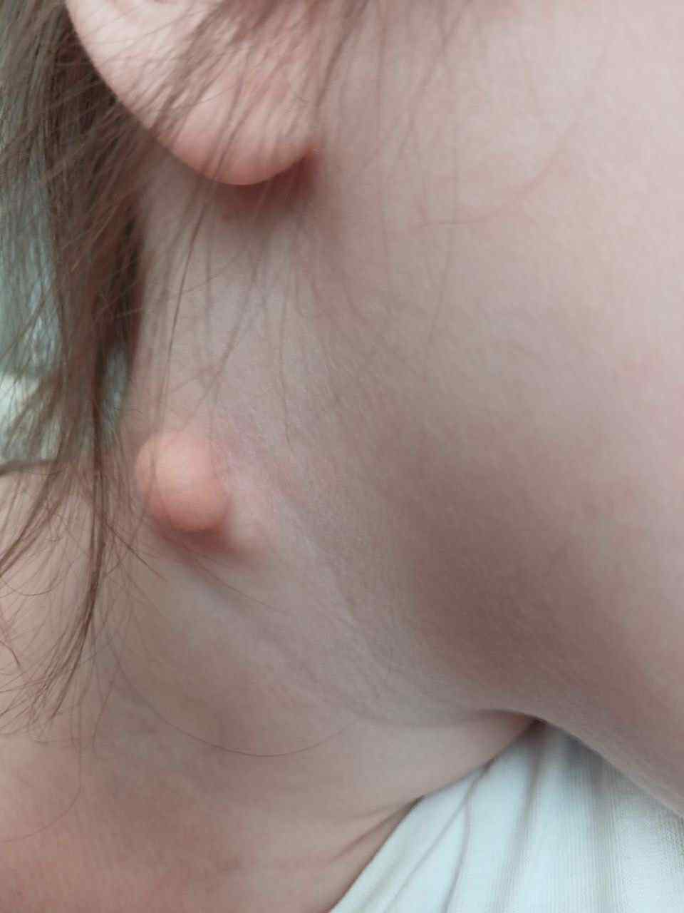 Кіста на шиї