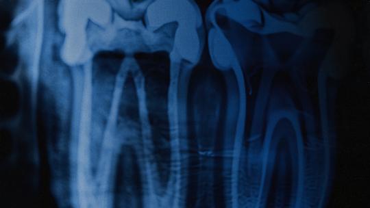 Ренген щелепи