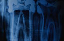 Ренген щелепи